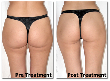 SLIMMING, Mesotherapy for cellulite