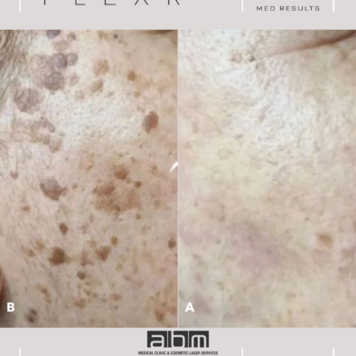 SKIN TAG REMOVAL