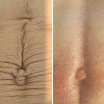 Tummy Tuck